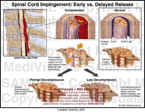 spinal cord compression test|spinal cord impingement vs compression.